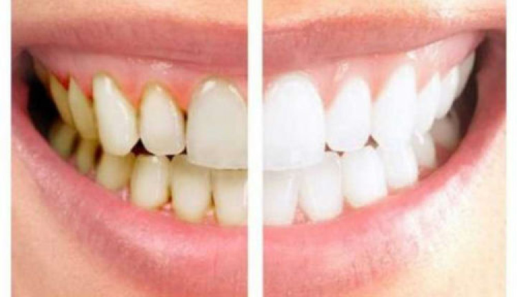 Зъболекар изброи 5-те причини за образуване на зъбен камък