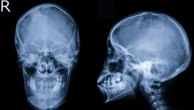 Той имаше ужасни главоболия, ето какво откриха лекарите в черепа му СНИМКА