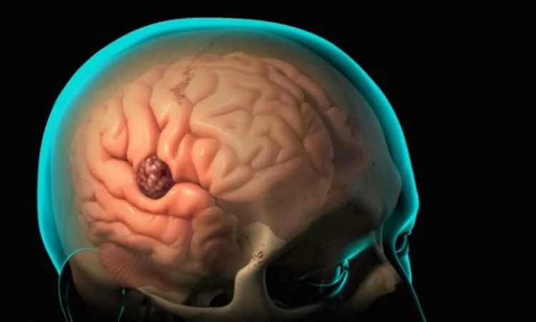 Онколог изброи симптомите на рак на мозъка