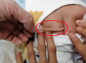 Бебе се роди с опашка, дълга 10 сантиметра, лекарите обясниха защо ВИДЕО