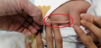 Бебе се роди с опашка, дълга 10 сантиметра, лекарите обясниха защо ВИДЕО