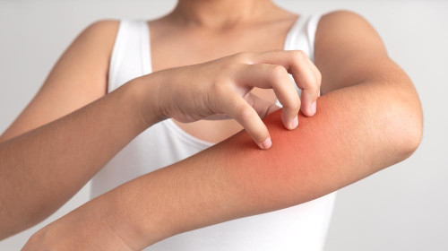 Д-р Мариян Иванов: Слънчева алергия се профилактира с хомеопатия