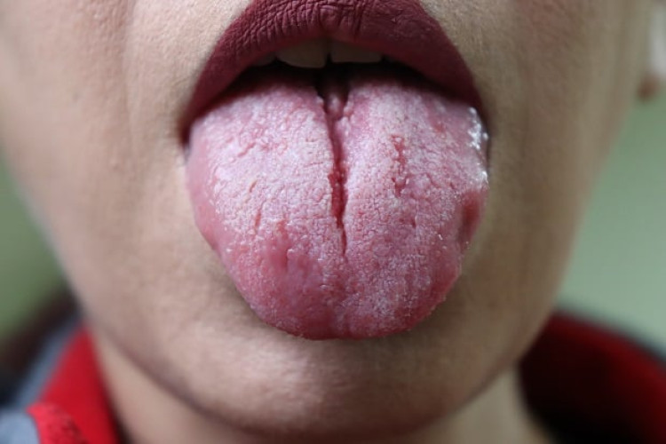 Лекар: Браздите по езика могат да издават проблем