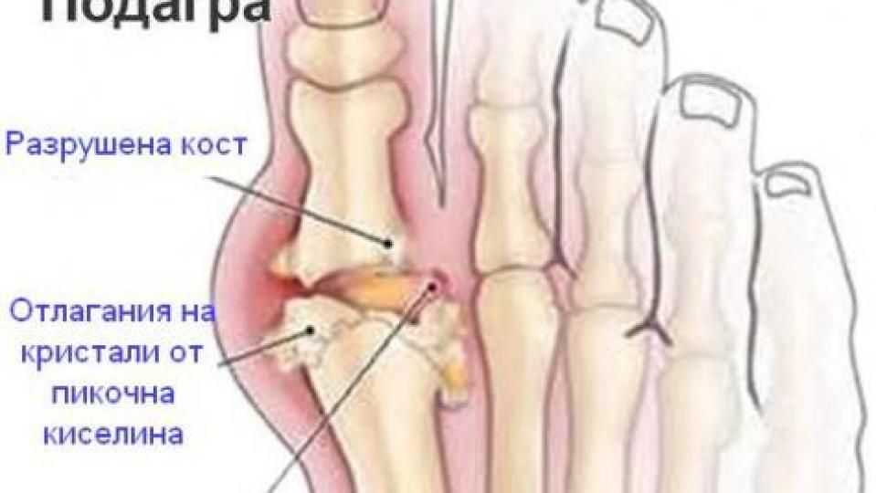 Как да спрем нетърпимите болки при подагра
