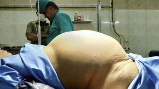 Медицинско чудо! Отстраниха близо 12-килограмов тумор от яйчника на "бременна" пенсионерка (СНИМКИ 18+)