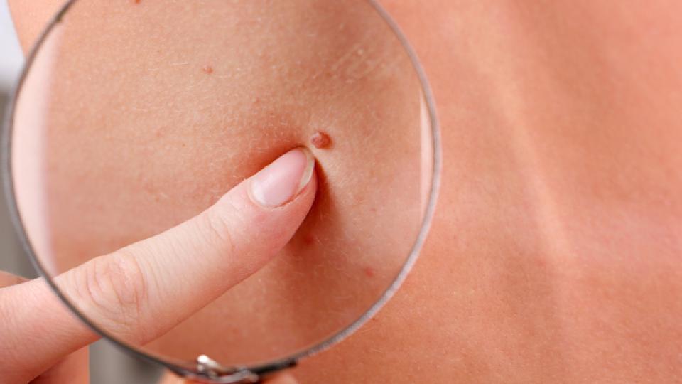 4 симптома, които издават за рак на кожата