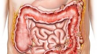 4 симптома, които издават сериозни проблеми с червата