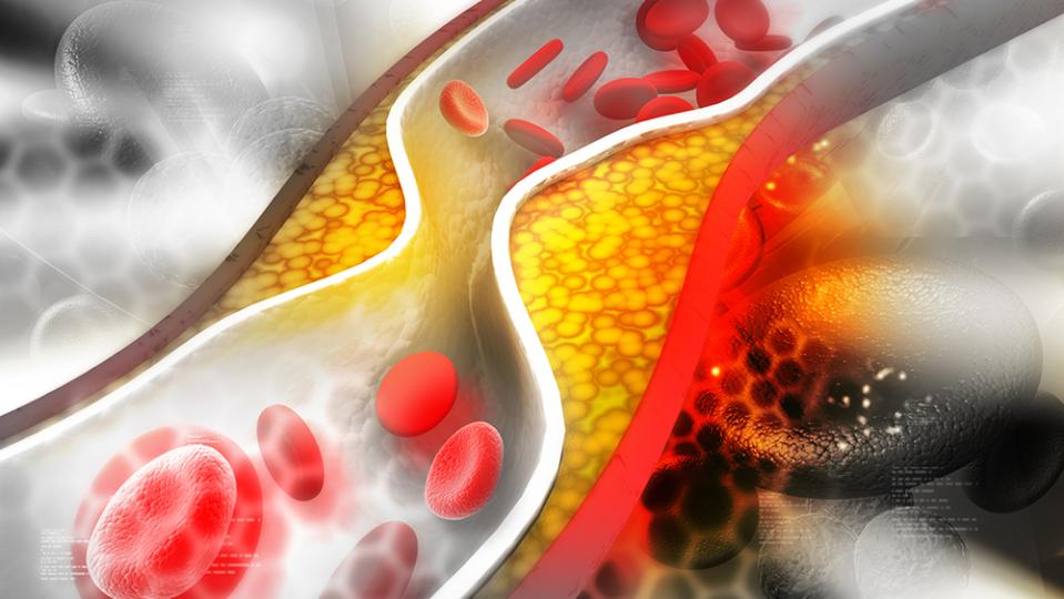 Холестеролът не е причина за атеросклерозата