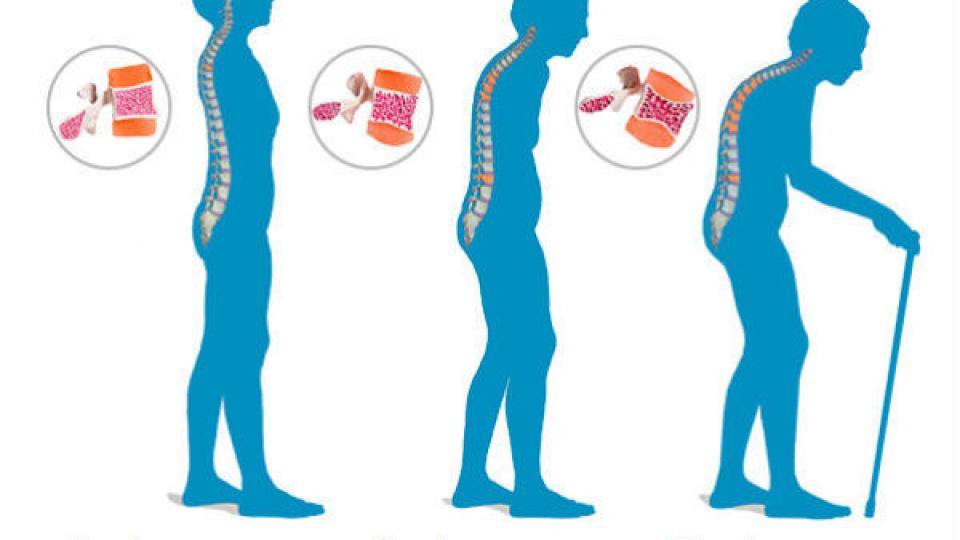 Учени откриха лесен начин за лекуване на остеопорозата