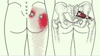 2 трика, които отключват седалищния нерв и облекчават болката след няколко минути! (СНИМКИ)