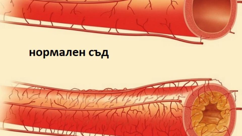 Само 50 мл. на ден от тази мощна напитка почиства артериите и предотвратява сърдечен удар!