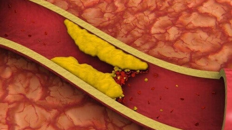 Ранни признаци, алармиращи за висок холестерол