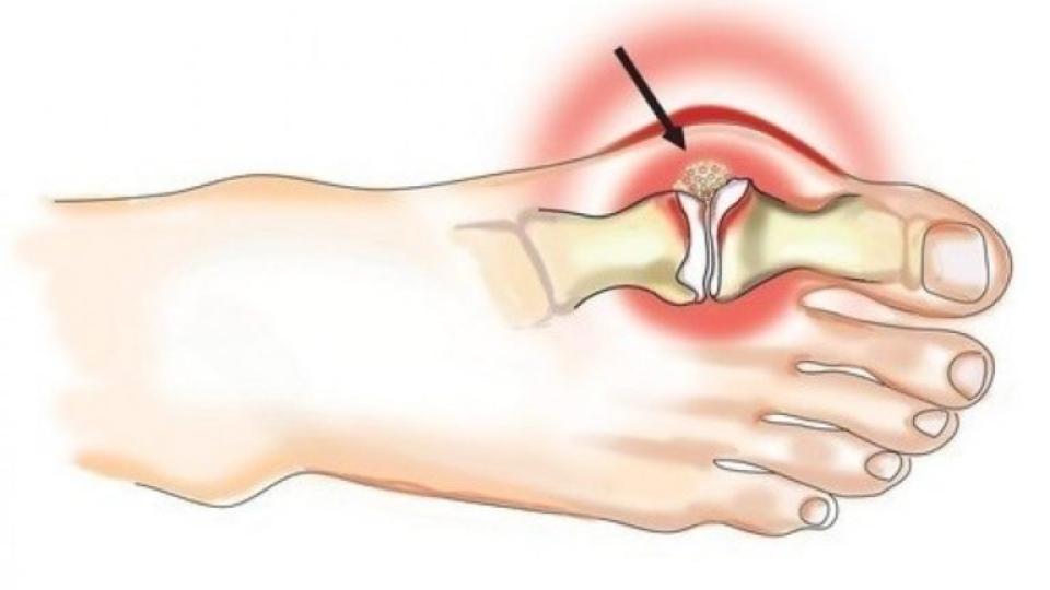 Подагра: Домашно средство за премахване на солта от ставите