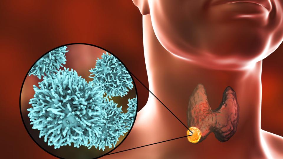 6 признака на рака  на щитовидната жлеза