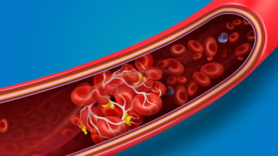 Първи признаци на образуване на кръвни съсиреци