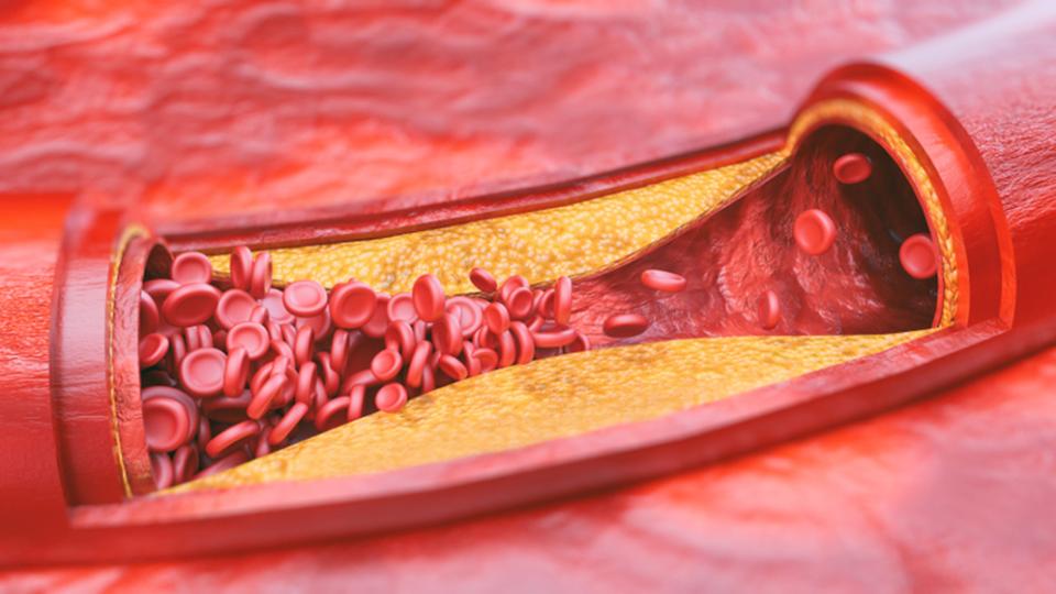 Изпитани рецепти при атеросклероза