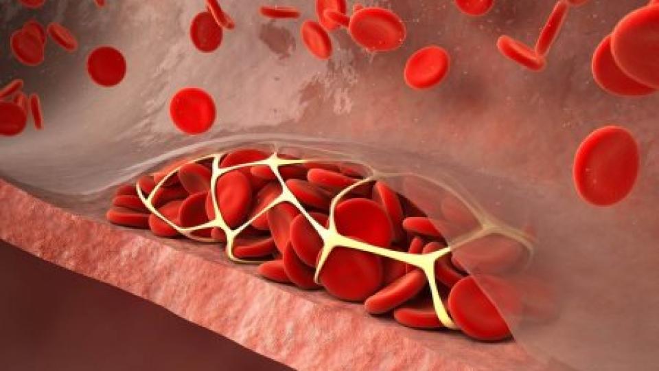 Лекари обясниха как да разпознаете образуването на кръвен съсирек по време на сън