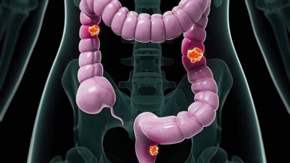 Четири вида болка, които могат да сигнализират за тумор в червата