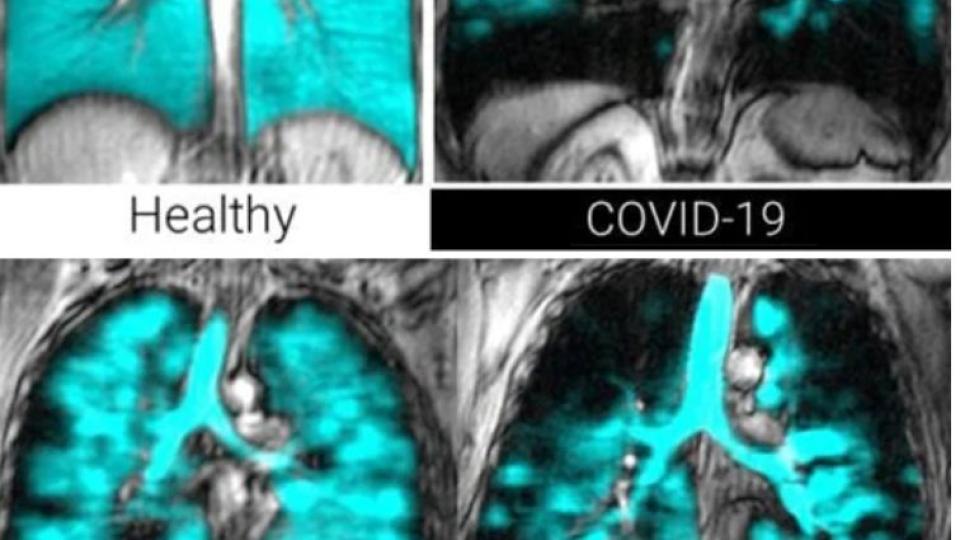 СНИМКА ясно показа източника на дълготраен Covid в белите дробове