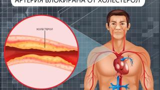 Oчите издават високия холестерол