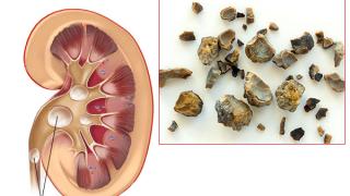Д-р Богатирев изброи предупредителните признаци за камъни в бъбреците