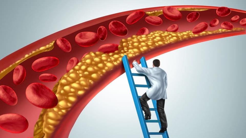 Какво ще помогне за понижаване на холестерола без лекарства?