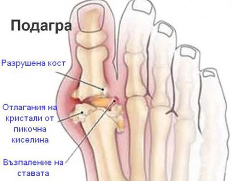 Как да спрем нетърпимите болки при подагра