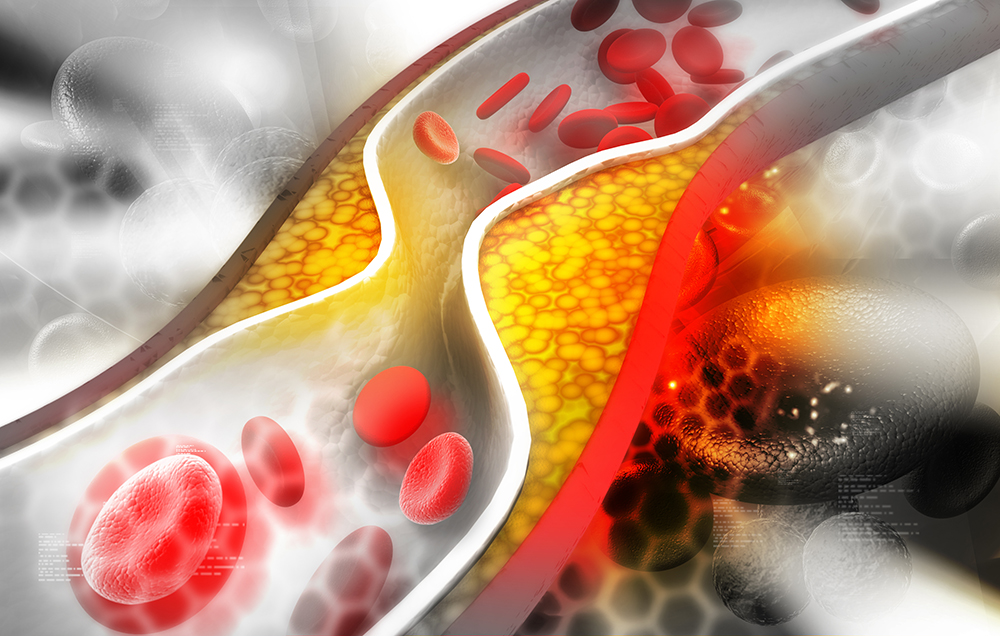 Холестеролът не е причина за атеросклерозата