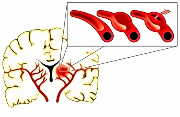 Първите признаци на аневризма в мозъка