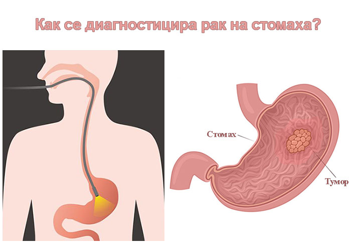 Четири ранни симптома на рак на стомаха