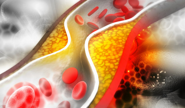 Лекар посочи 4 правила за намаляване на "лошия" холестерол