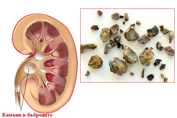 Д-р Богатирев изброи предупредителните признаци за камъни в бъбреците